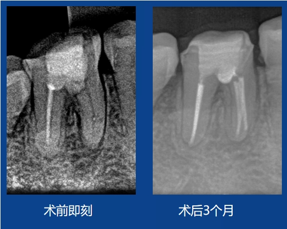 刘杰先生案例——髓室底穿孔修复