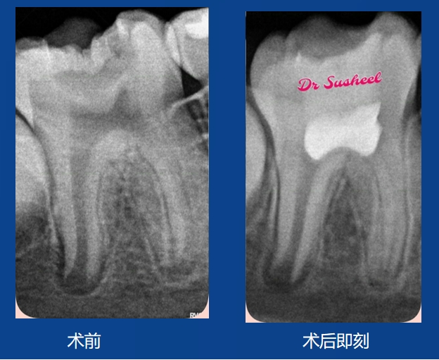 Susheel先生案例——活切直接盖髓